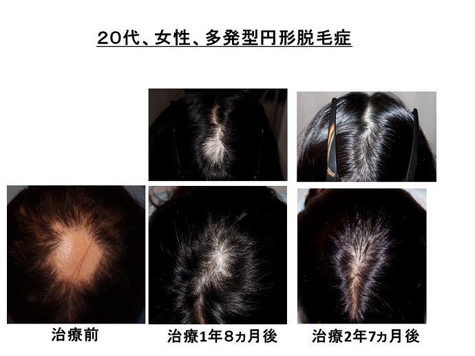 円形脱毛症　病院